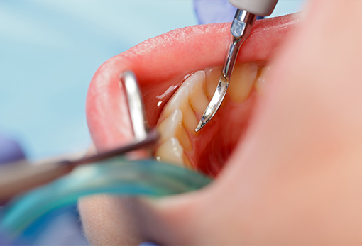 診療案内_07 予防・クリーニング_コラム 歯垢と歯石の関係